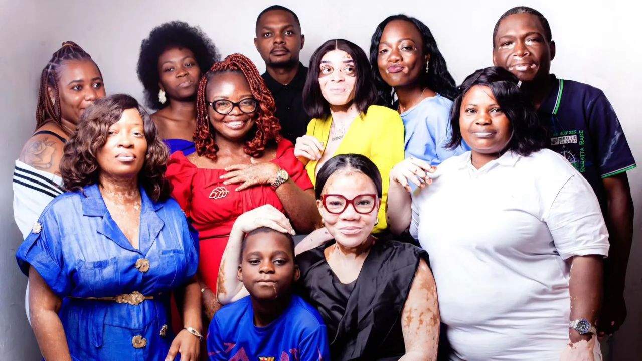 Journée mondiale du Vitiligo: Briser  les préjugés autour d'une maladie encore méconnue